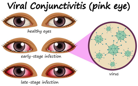 人眼疾病与病毒性结膜炎图片