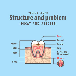 齿图中的衰变和脓肿横断面结构
