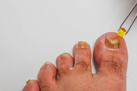 足脚细菌感染图片