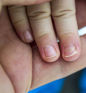 小儿指甲再生婴儿指甲下降重新出现手指甲,手足病和指甲下降.照片