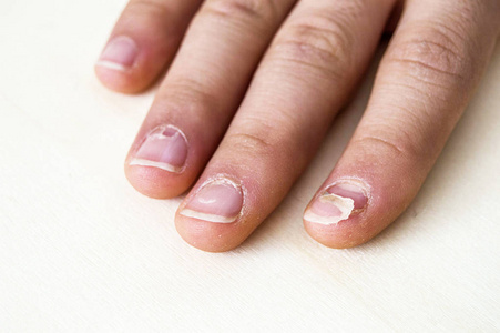 小儿指甲再生婴儿指甲下降重新出现手指甲手足病和指甲下降。图片