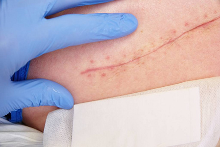 肢体石膏医生手移除石膏检查髋关节手术后皮肤照片