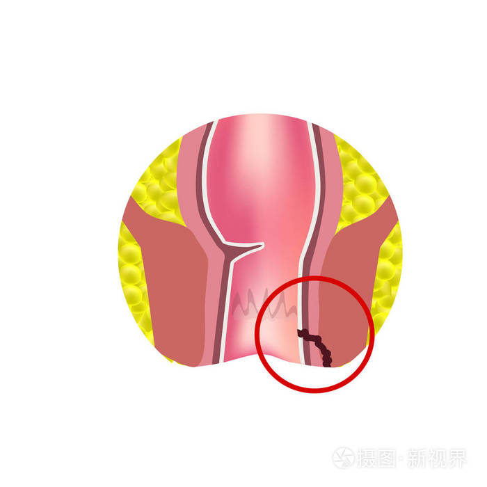 皮下瘘真实图片图片