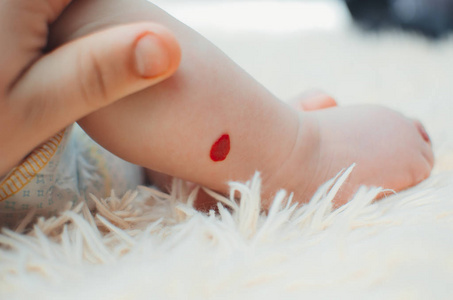 混合型血管瘤图片