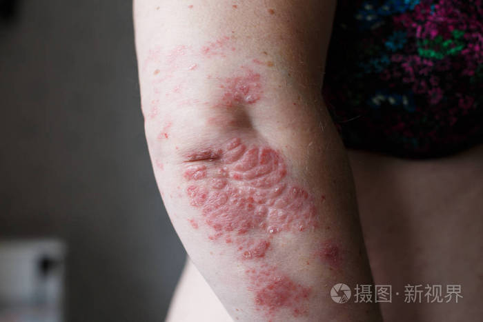 牛皮癣皮肤.