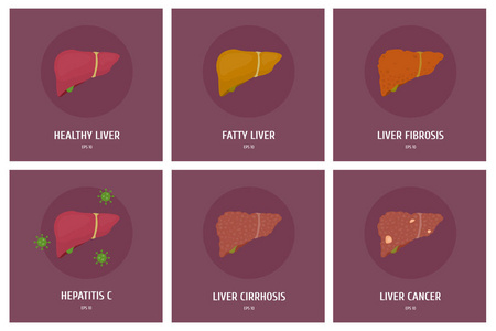 一套健康的肝脏及其各种疾病肝炎癌症肥胖肝硬化。 矢量平面图