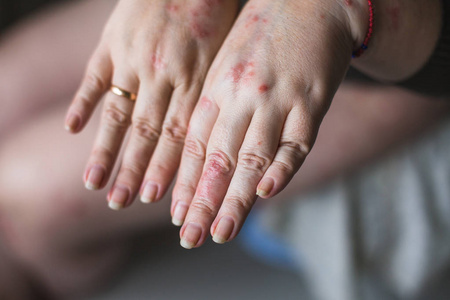 寻常的银屑病在女人手上有斑块, 皮疹和皮肤上的补丁, 在白色背景下隔离。自身免疫性遗传疾病。健康理念
