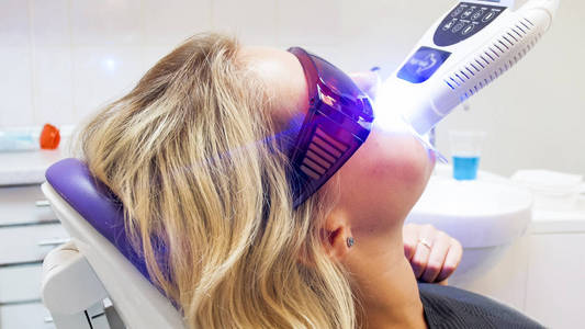 牙科诊所年轻女子用紫外线美白牙齿的特写镜头