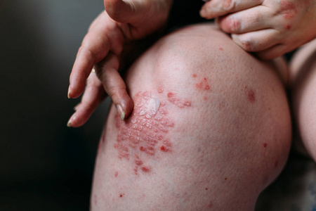 湿疹和其他干燥皮肤的情况下, 应用润肤剂干燥片状皮肤