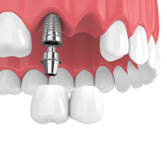 牙悬臂桥植入物在上颌骨的三维渲染在白色背景上分离