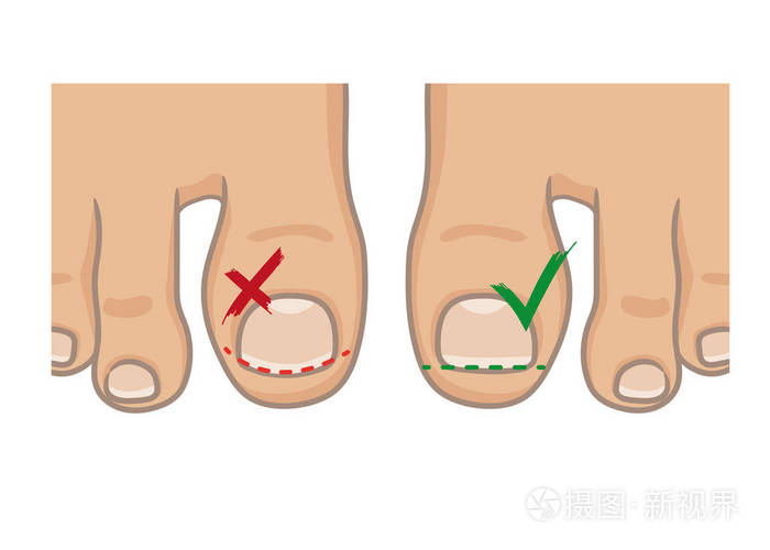 如何切割脚趾甲的对错概念 如何避免内钉 女性或男性足底赤脚俯视 矢量插图手绘卡通风格孤立在白色上 插画 正版商用图片11yjbx 摄图新视界