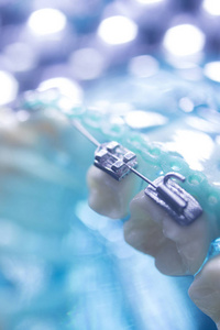牙齿固定金属对齐托槽，以矫正牙科治疗中的牙齿。