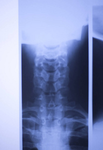 医疗医院x射线腰痛脊柱和颈部创伤扫描。