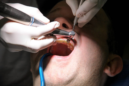 牙齿抛光。 牙齿清洁牙齿卫生。 牙科医生在他的牙科诊所和办公室工作，正在用工具，镜子，软牙刷和口腔吸管抛光病人的牙齿。