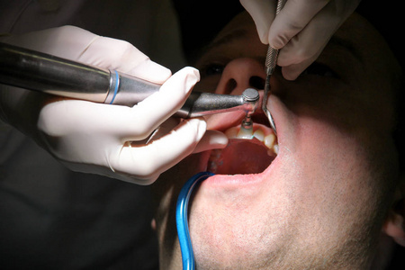 牙齿抛光。 牙齿清洁牙齿卫生。 牙科医生在他的牙科诊所和办公室工作，正在用工具，镜子，软牙刷和口腔吸管抛光病人的牙齿。