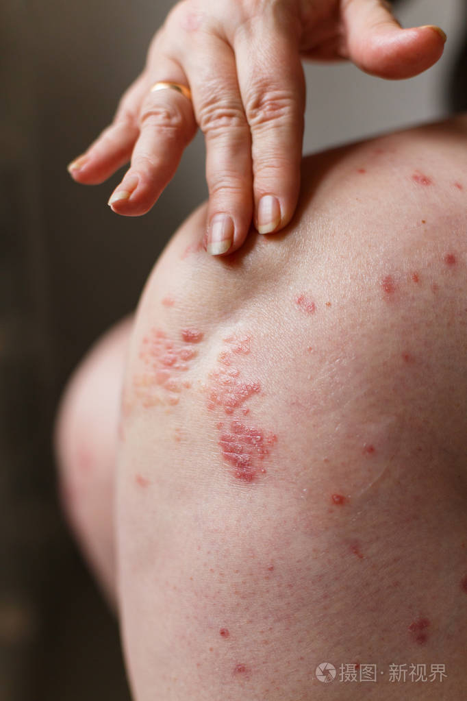 特写妇女瘙痒和抓牛皮癣斑的手. 皮肤上的银屑病或湿疹.