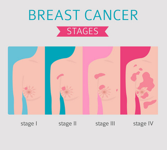 乳腺癌医学信息图表。 诊断症状治疗。 女性健康套装。 矢量插图