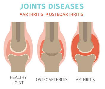 关节疾病。关节炎，骨关节炎症状，治疗图标设置。医学信息设计。矢量图