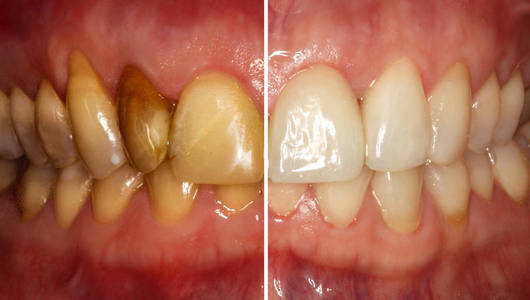 修复前后的额牙。