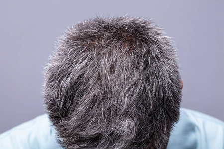 有头皮屑的成熟男人挠头照片