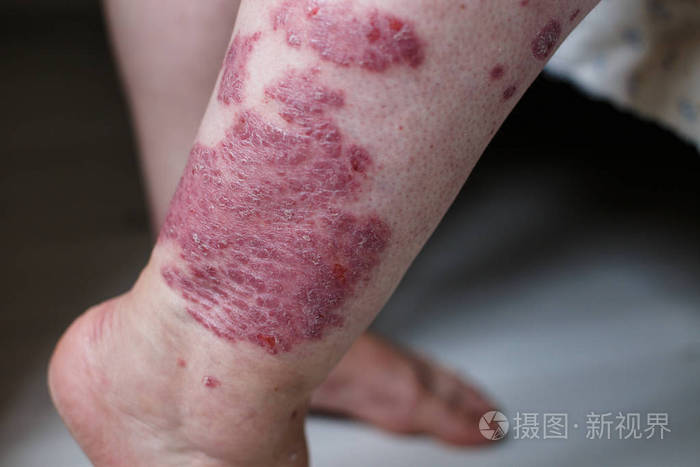 皮肤鸡皮疙瘩是湿疹吗(鸡皮疙瘩凸起是皮疹还是湿疹)