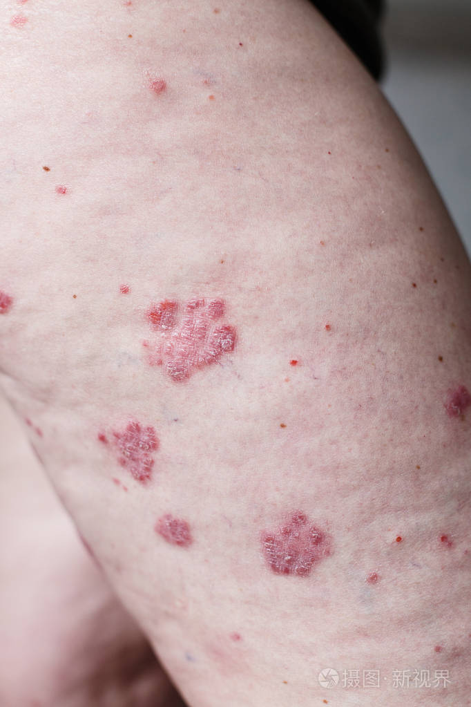 皮疹的症状和治疗早期图片