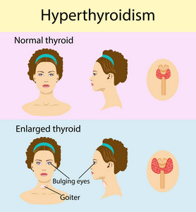 甲状腺肿大的妇女。矢量插图