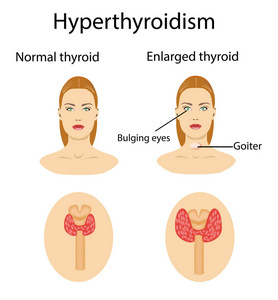 甲状腺肿大的妇女。矢量插图