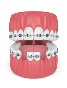牙齿的三维渲染与正畸牙套和蛀牙。 正畸牙套概念