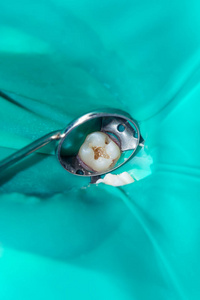 在牙科诊所的治疗阶段关闭一颗人类腐烂的龋齿。 橡胶坝系统与乳胶围巾和金属夹生产光聚合复合填料
