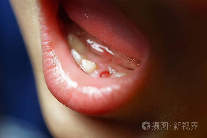 一个六岁的男孩有他的第一颗婴儿牙齿的照片故事下颌牙龈大片