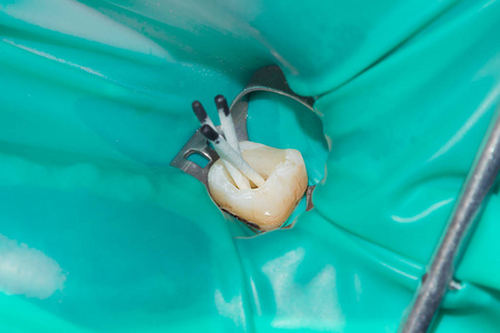 腐烂的龋齿关闭宏观. 根管治疗照片