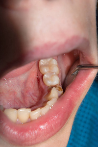 龋齿的阶段图片