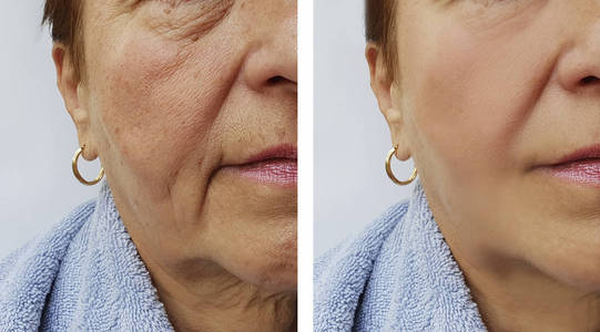 一位年长妇女的脸在手术前后出现皱纹