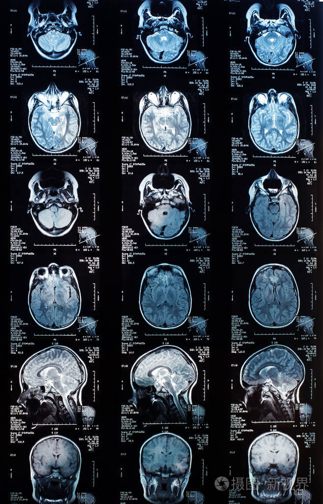 脑磁共振图像mri