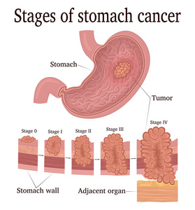 胃癌恶性肿瘤的发展阶段