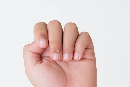 s fingers with dry skin, Eczema Dermatitis. Medicine and health 