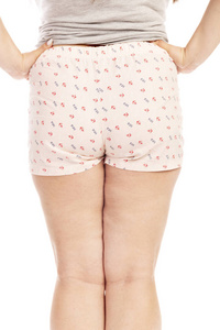 一个肥胖妇女的腿与脂肪团隔离在白色背景