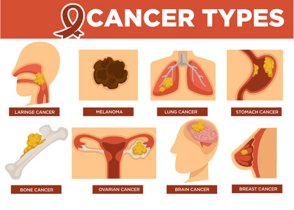 癌症类型海报与各种疾病载体。 拉林肺胃骨卵巢癌和脑乳腺癌和黑色素瘤。 严重疾病伴恶性细胞结肠集中于一个区域