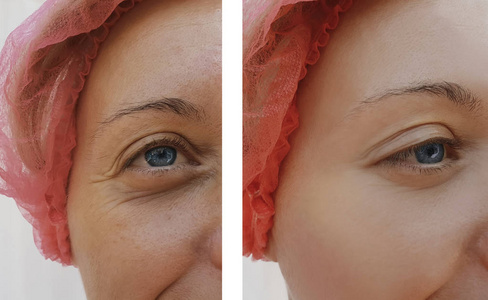 治疗前后女性眼部皱纹