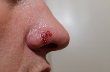 男子鼻子上疱疹的感冒照片