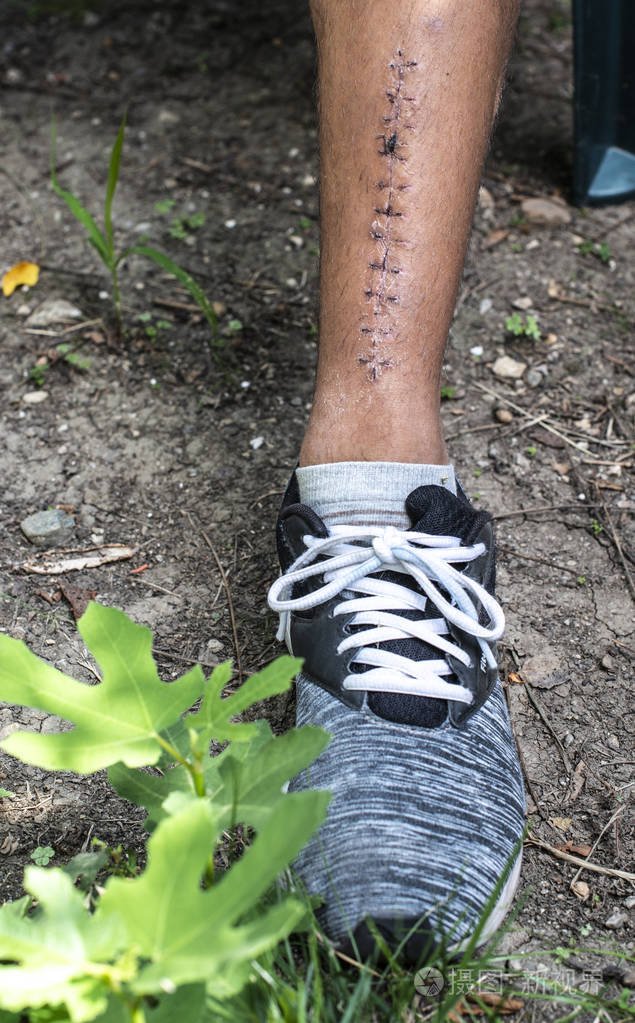 缝合腿伤. 穿运动鞋的男孩