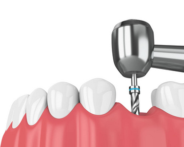牙种植体钻头对颌骨的三维渲染。 植入过程概念。