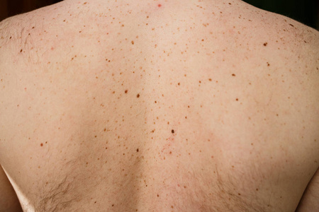 关闭裸露的皮肤的细节, 一个人背部与分散的痣和雀斑, 身体的障碍, 检查良性痣, 阳光对皮肤的影响。皮肤上的胎记