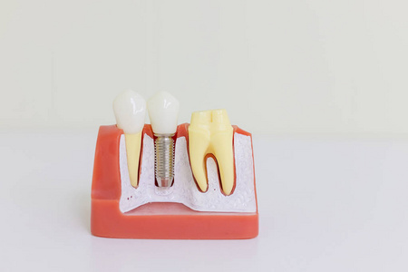 牙科植入模型。牙人植入物。牙科概念。人牙或假牙。Implan 模型齿支承固定桥 Implan 和冠。普通牙种植体研究分析冠桥