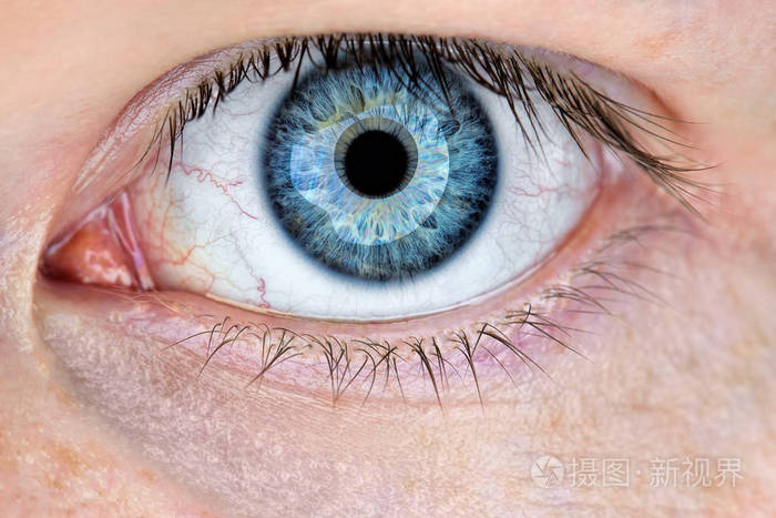 s red eye. macro of conjunctivitis or irritation red bloodshot e
