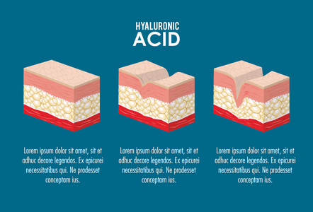 透明质酸填料注入信息图