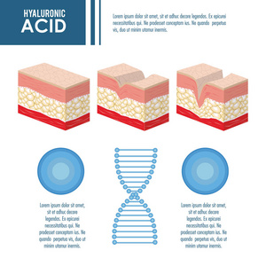 透明质酸填料注入信息图