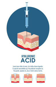 透明质酸填料注入信息图