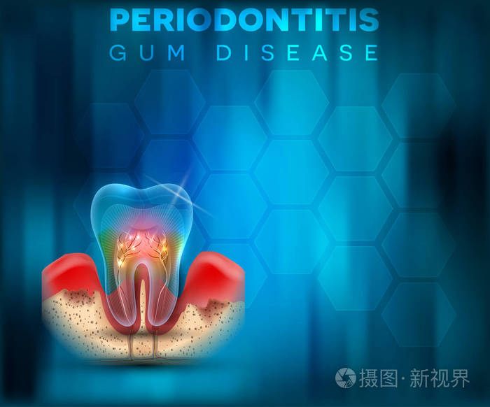 牙周炎牙龈疾病海报 牙龈发炎背景亮蓝色插画 正版商用图片13hzr7 摄图新视界